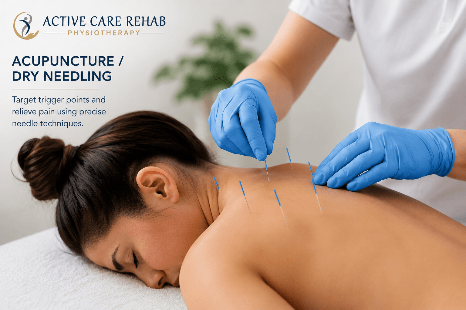 Acupuncture and Dry Needling